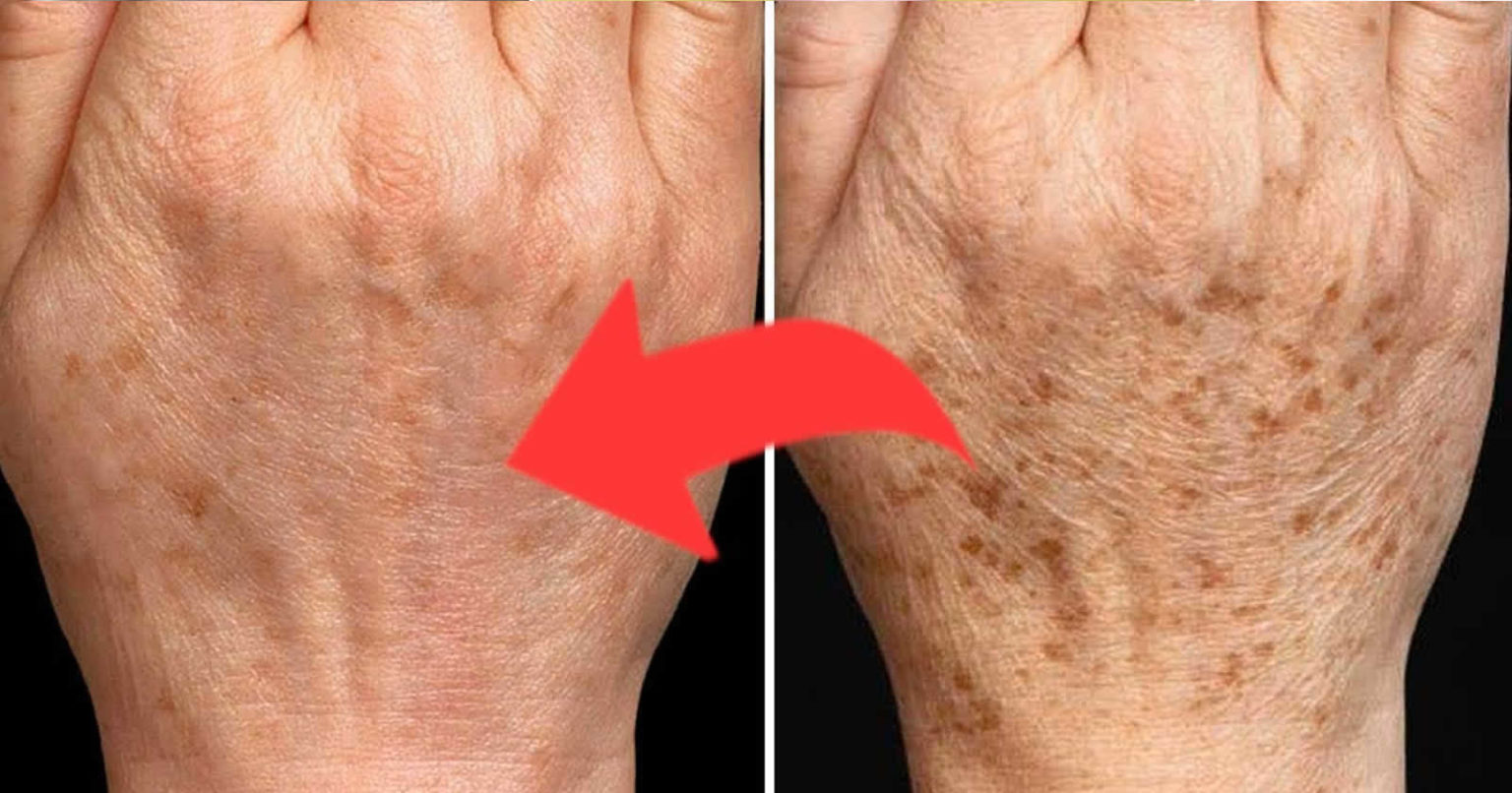 Σημάδια γήρανσης στα χέρια; ΠΟΤΕ Πια! Ο πιο απλός τρόπος