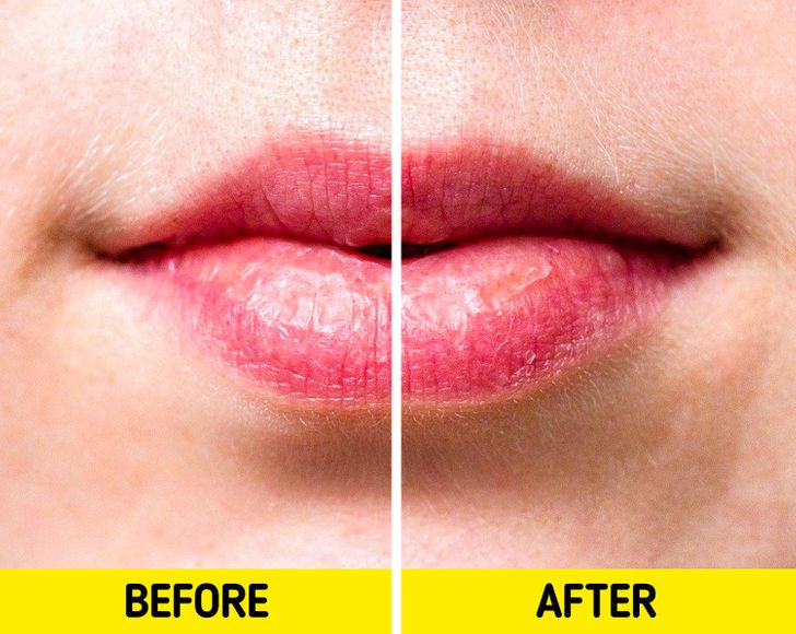 Τι θα Συμβεί στα Χείλη σας αν Χρησιμοποιείτε Συχνά Lip Balm