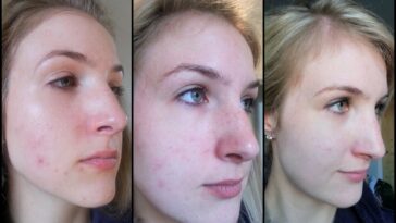Τι θα συμβεί αν δεν καθαρίσετε το μακιγιάζ από το πρόσωπο σας image: laurenlovesblog