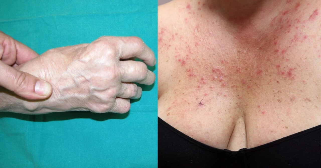 Αυτά είναι τα 5 αυτοάνοσα νοσήματα που «χτυπάνε» τις γυναίκες: Τα ύπουλα συμπτώματα – Πότε να πάτε στον γιατρό