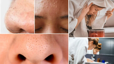 Αφαιρέστε Όλα τα Μαύρα και Λευκά Στίγματα με 5 Εύκολα Βήματα στο Σπίτι