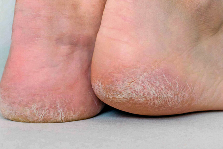 Σκασμένες Φτέρνες και Αιτίες: 8 «ύπουλοι» Λόγοι που πιθανώς αγνοείτε