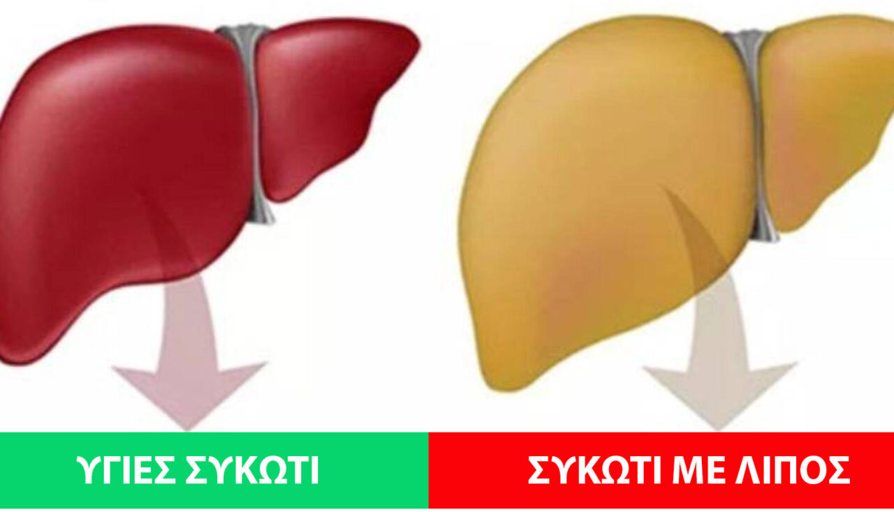2 στους 5 Ανθρώπους έχουν Λίπος στο Συκώτι και Δεν το Γνωρίζουν. Δείτε 10 Φυσικούς Τρόπους για το Αποτοξινώσετε