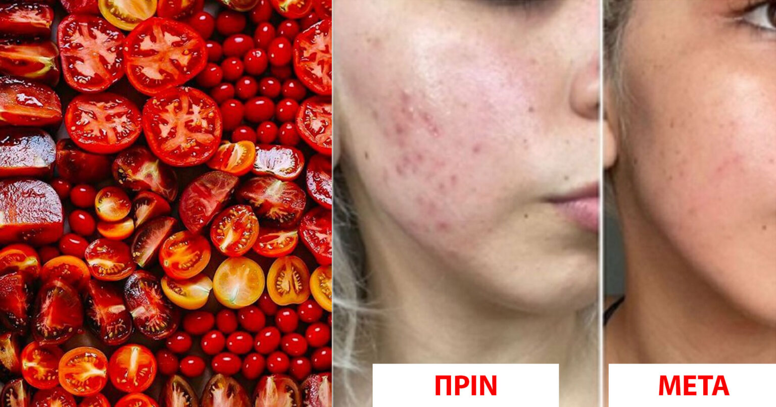 Αντιμετωπίστε το 99% των Δερματικών Προβλημάτων του Προσώπου με Σπιτικό Τζελ Ντομάτας