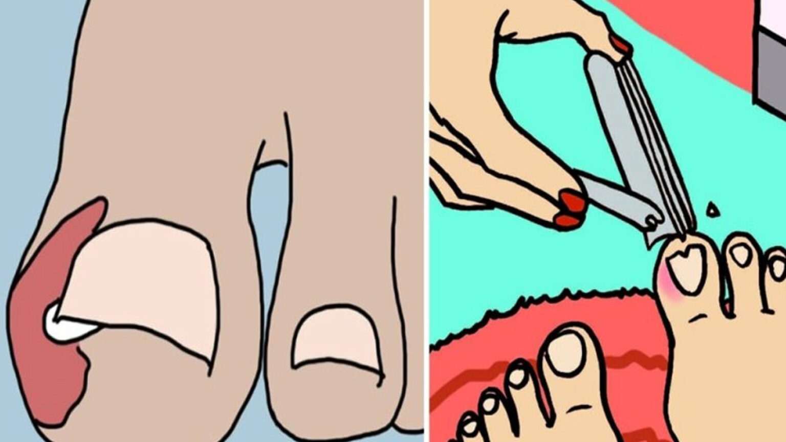 Νύχι που σου μπαίνει στο δέρμα; Αυτό μπορείς να κάνεις στο σπίτι σου