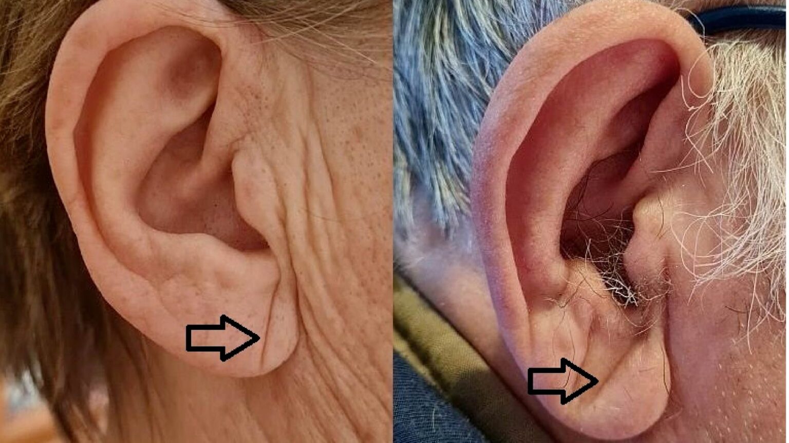 Το «σημάδι του Φρανκ»: Οι πτυχές στον λοβό του αυτιού που μπορεί να είναι σημάδι αυξημένου κινδύνου εγκεφαλικού