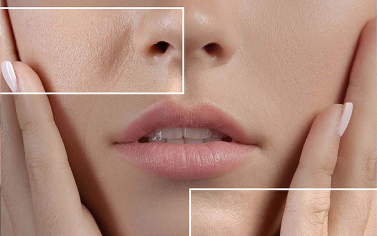 Ανοιχτοί Πόροι Αντιμετώπιση: Απαλλάξτε το Πρόσωπό σας με Αυτήν τη Φυσική Θεραπεία 4 Βημάτων