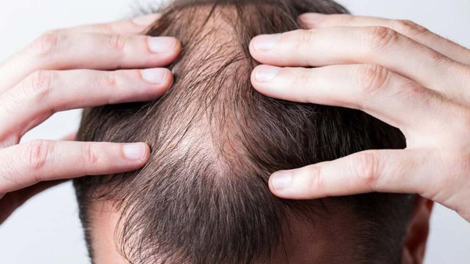 Ποια Προβλήματα Υγείας Αποκαλύπτει η Κατάσταση των Μαλλιών σας