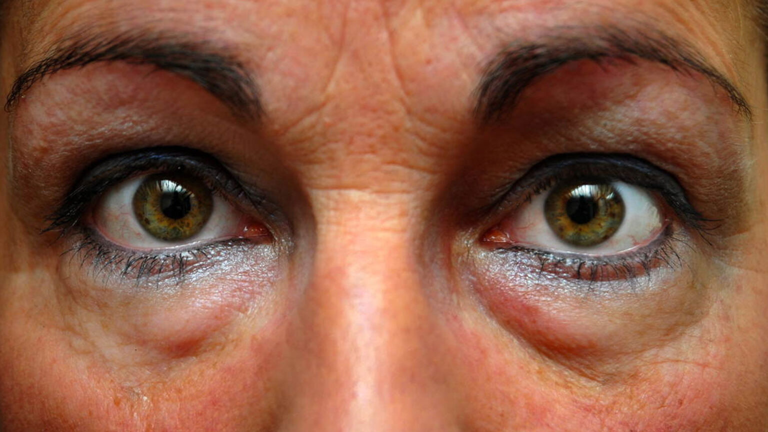 Μαύροι κύκλοι και σακούλες στα μάτια. Φυσικά μέσα, σπιτικές μάσκες ματιών για αντιμετώπισή τους