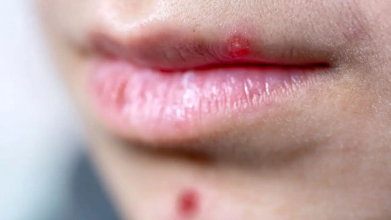 7 Συμβουλές για να Εξαφανίσετε Γρήγορα ένα Σπυράκι στα Χείλη