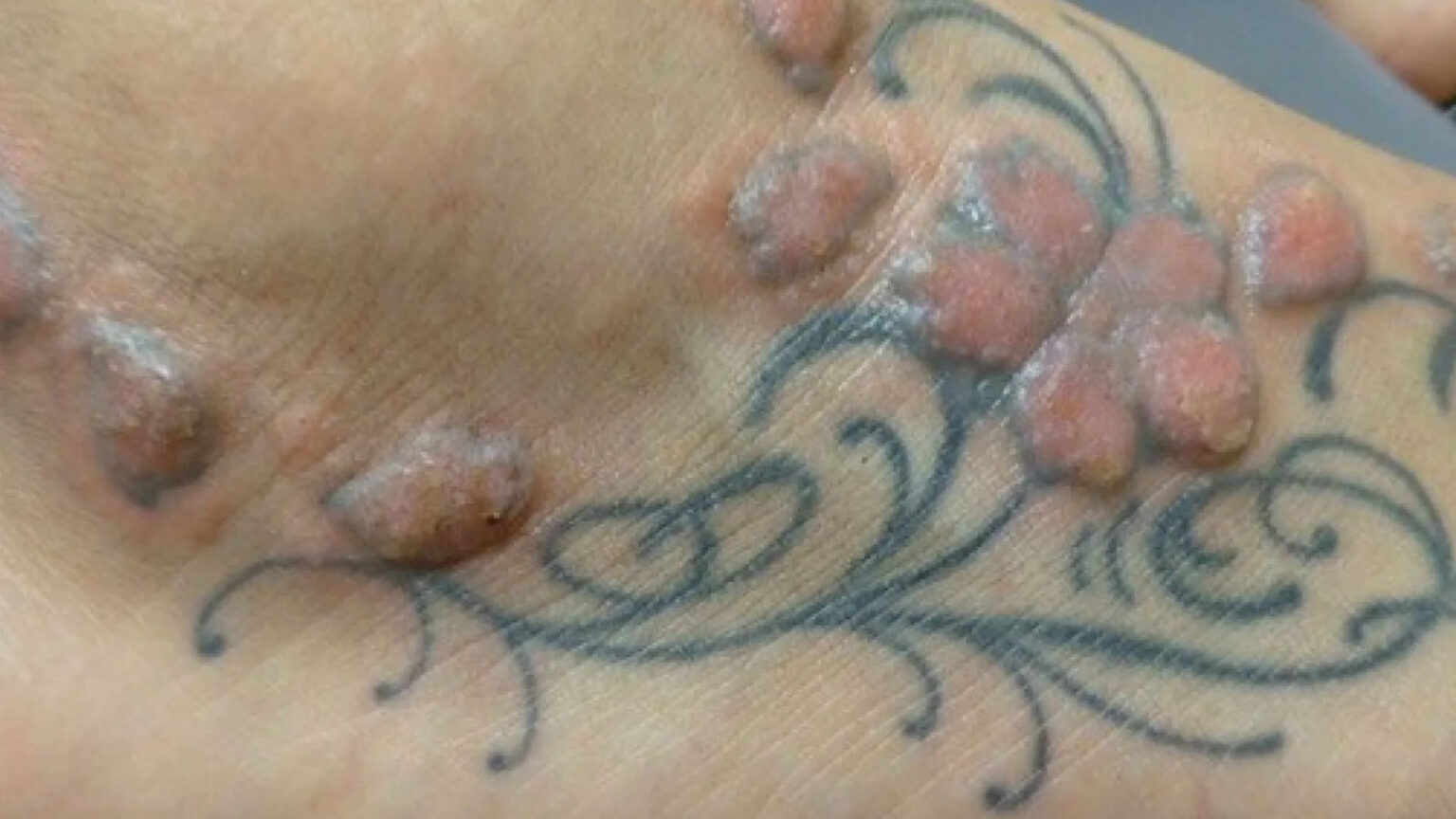 Τα Τατουάζ Μπορεί να Μολύνουν με Καρκινογόνα Βαρέα Μέταλλα τους Λεμφαδένες σας