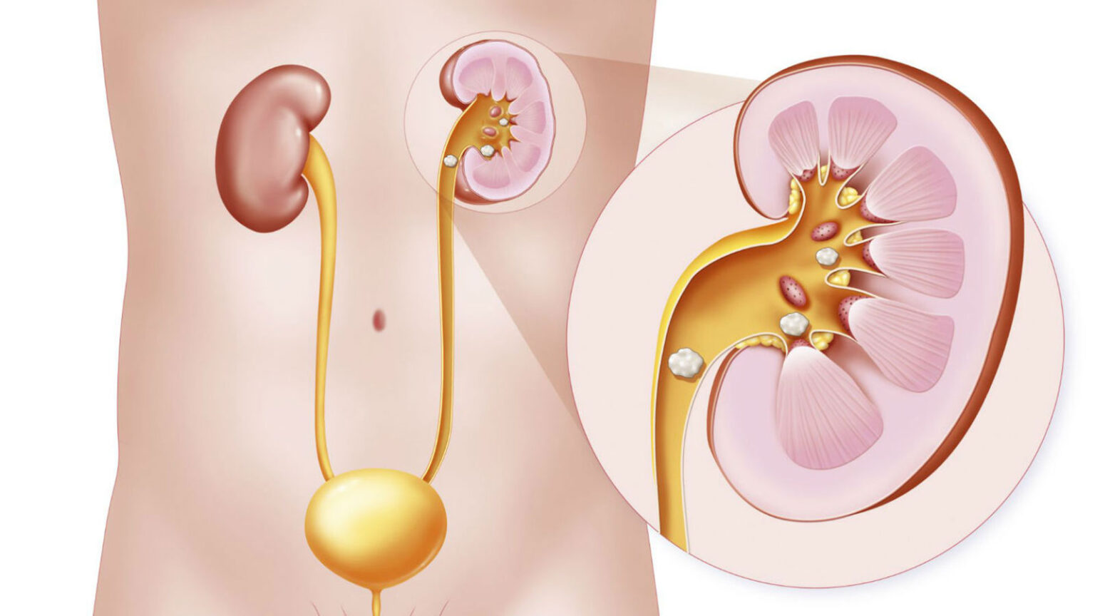 Πέτρες Στα Νεφρά: Αυξάνονται το καλοκαίρι οι Πιθανότητες - Τι να Κάνετε Για Αντιμετώπιση