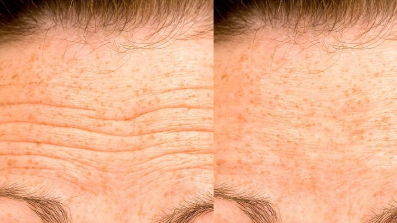 Ρυτίδες Στο Μέτωπο: Μπορεί να Είναι Γραμμές Αφυδάτωσης - Πώς να Απαλλαγείτε