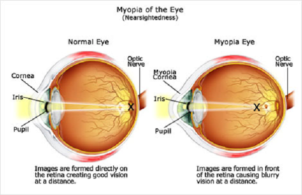 ήλιος και μυωπία,μυωπία,αντιμετώπιση μυωπίας,συμβουλέσ υγείασ,υγεία,φροντιδα ματιων