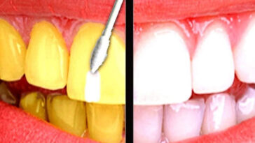 κίτρινα δόντια,λέυκανση κίτρινων δοντιών,σπιτική θεραπεία δοντιών,φροντίδα δοντιών,ομορφιά,συμβουλές ομορφιάς,