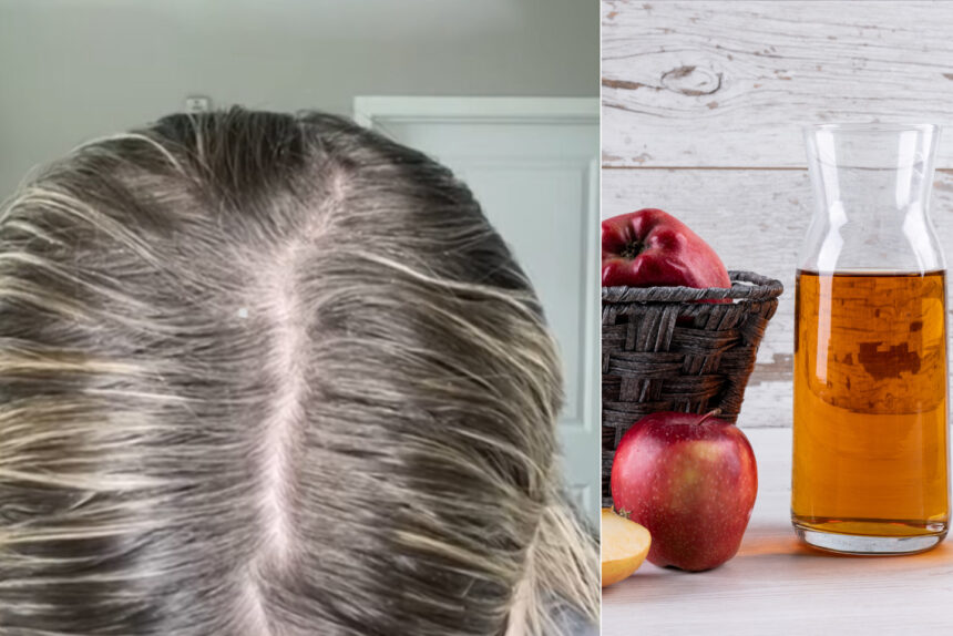 Φυσική Αντιμετώπιση για τα Λαδωμένα Μαλλιά: Το μηλόξυδο θα απομακρύνει την λιπαρότητα