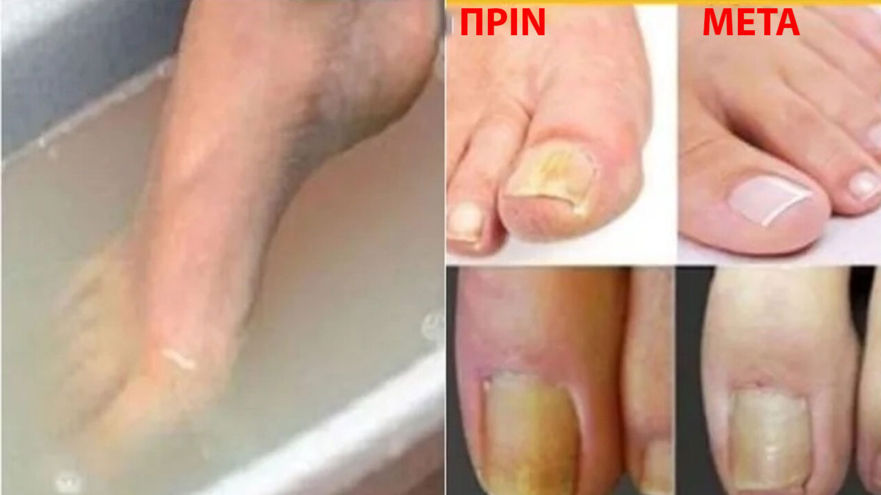 Μύκητες Στα Νύχια: Απαλλαγείτε για Πάντα με Μόνο 2 Συστατικά