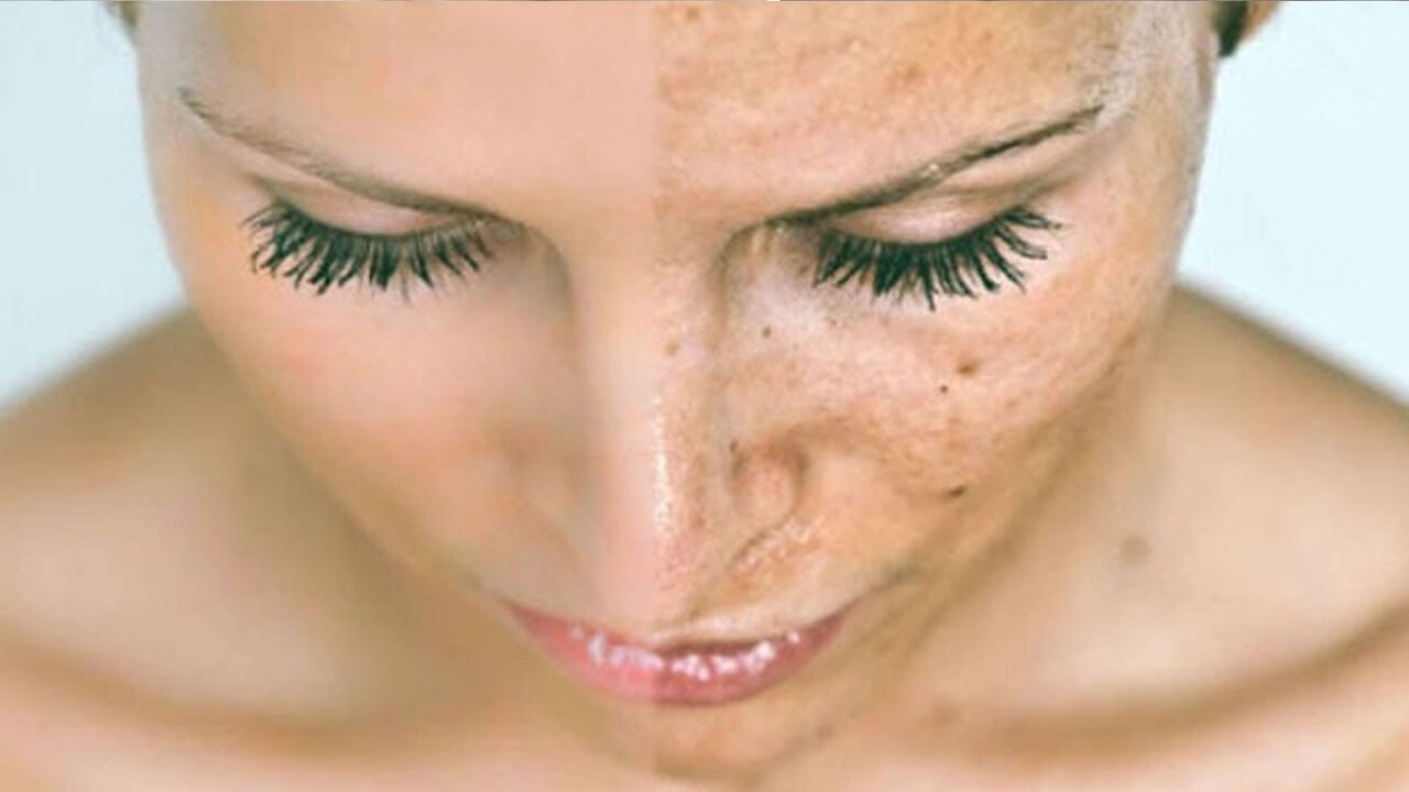 Αντιμετώπιση Πανάδων Στο Σπίτι