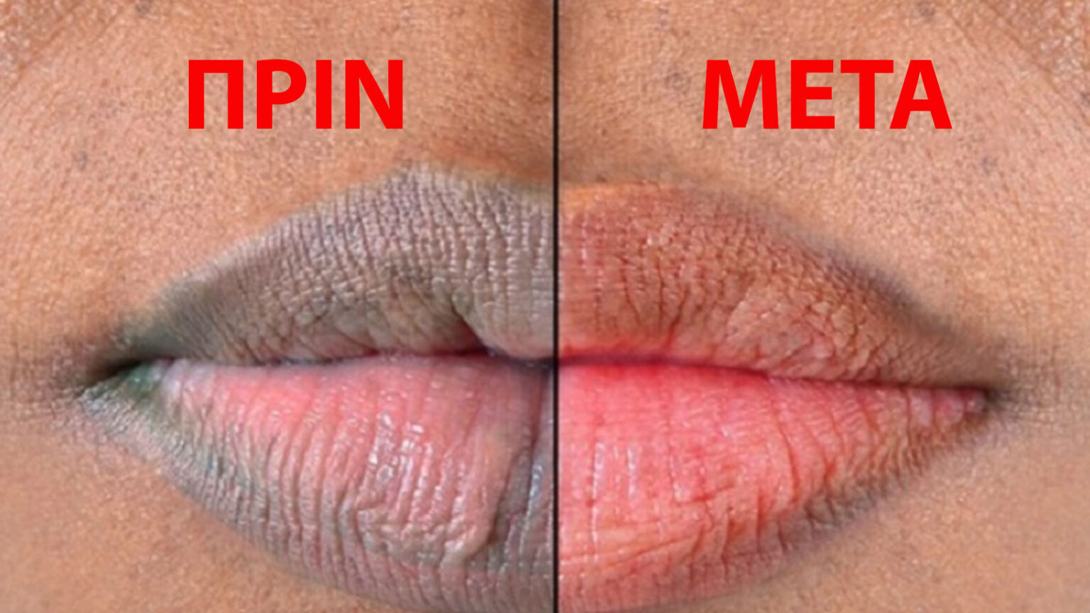 σκούρα χείλη,λεύκανση σκούρων χειλιών,φροντίδα χειλιών,συμβουλές ομορφιάς,ομορφιά,