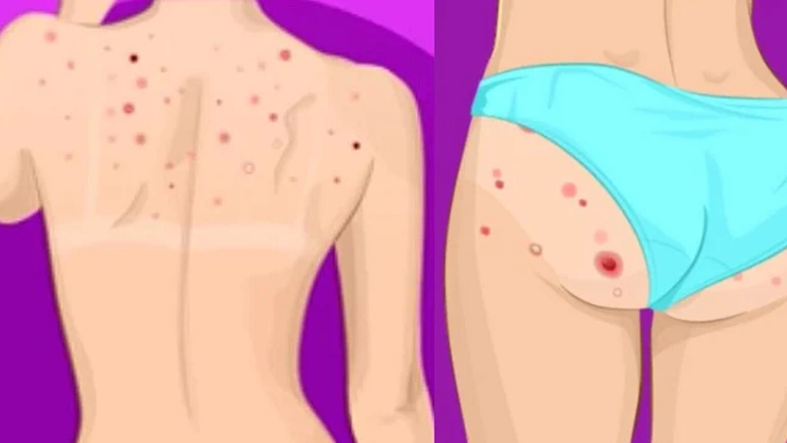 Σπυράκια στην Πλάτη και Στους Γλουτούς: Τι Σημαίνει Για την Υγεία Σας, Πώς Προκαλούνται