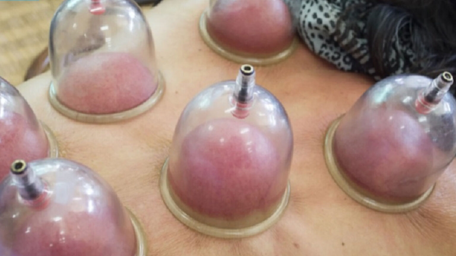 Βεντούζες: Η Επιστήμη Εξηγεί 5 Πράγματα που Συμβαίνουν στο Σώμα σας Όταν Τις Κάνετε