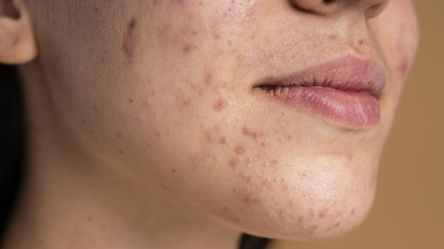 Αυτά είναι τα 7 Πράγματα που δεν πρέπει ποτέ να κάνετε στο δέρμα σας όταν έχετε ακμή