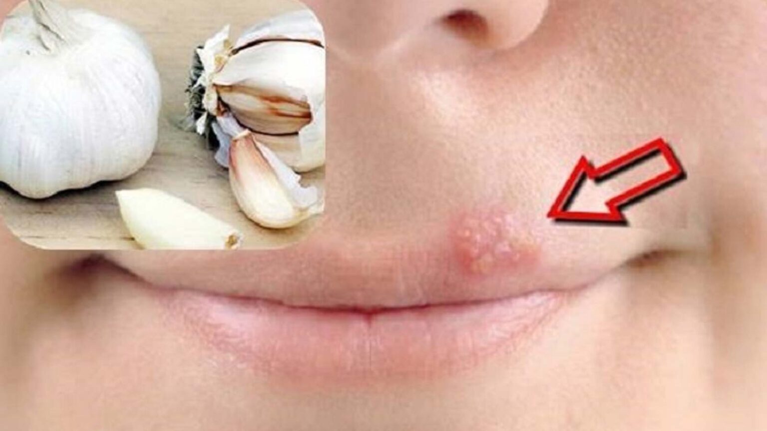 Έρπης Στα Χείλη: Απαλλαγείτε με Σκόρδο - Η φυσική αντιμετώπιση