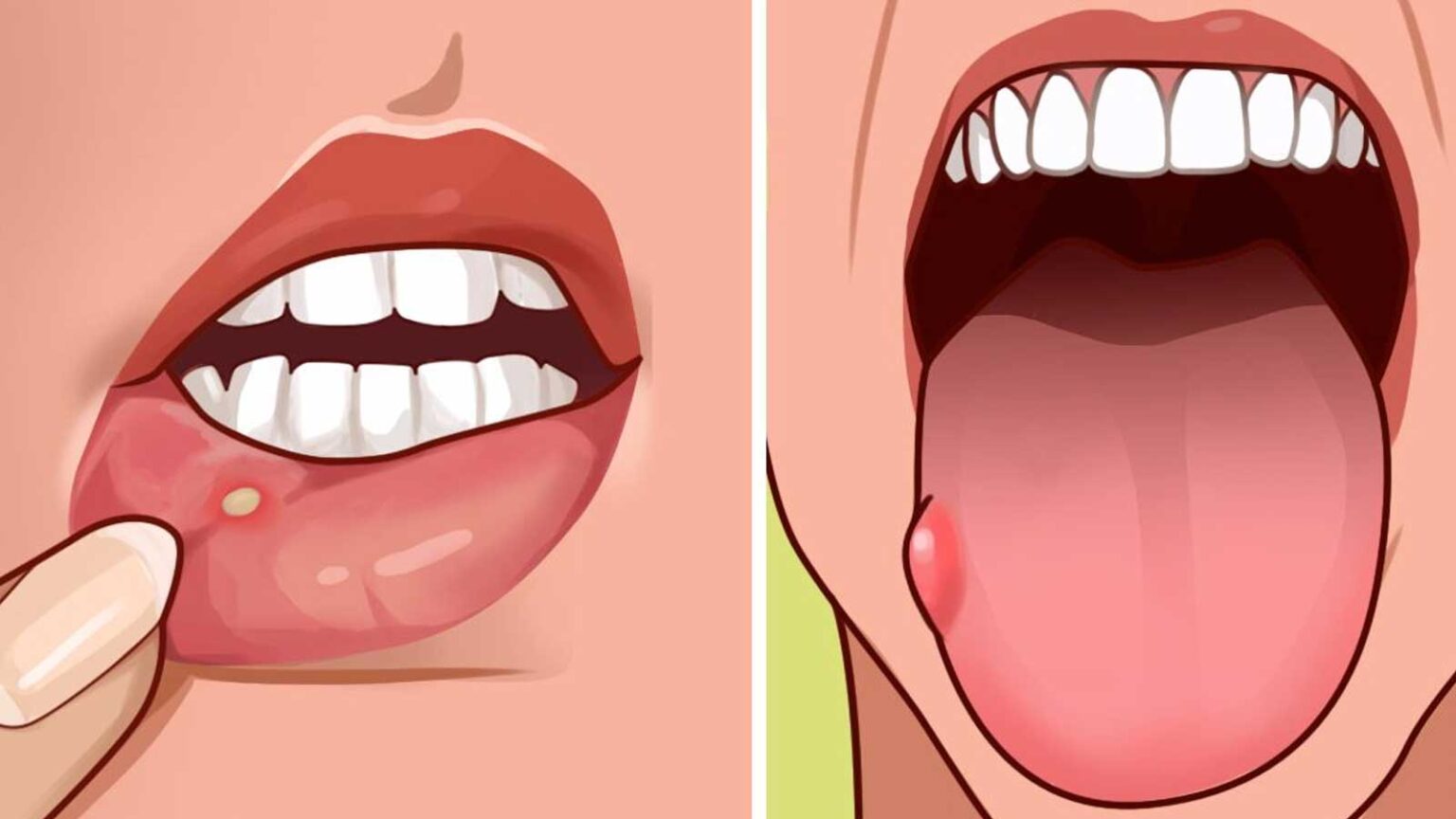 7 συμπτώματα έλλειψης του φυλλικού οξέος που συχνά αγνοούμε