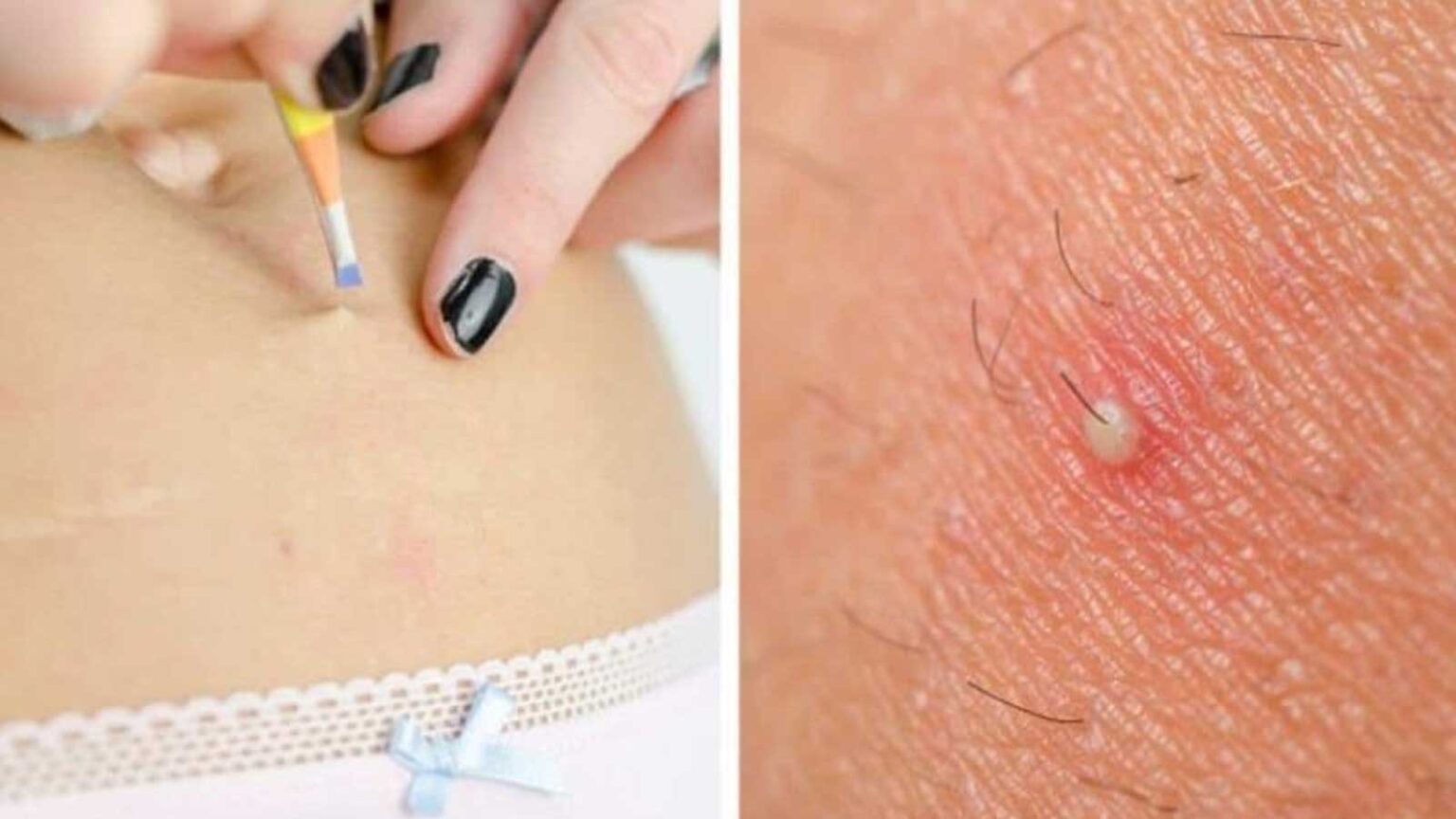 Τρίχες μέσα στο δέρμα: Το κόλπο για να απαλλαγείτε οριστικά και να αποφύγετε τις κύστες