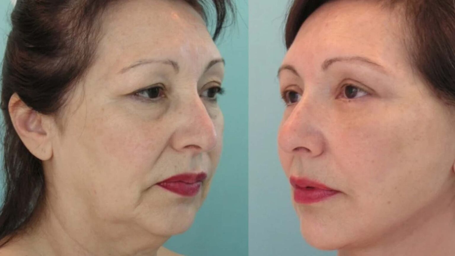 Γήρανση δέρματος και Ρυτίδες: Τα δυο υλικά που μπορούν να σβήσουν τα σημάδια του χρόνου κάτα 20 χρόνια