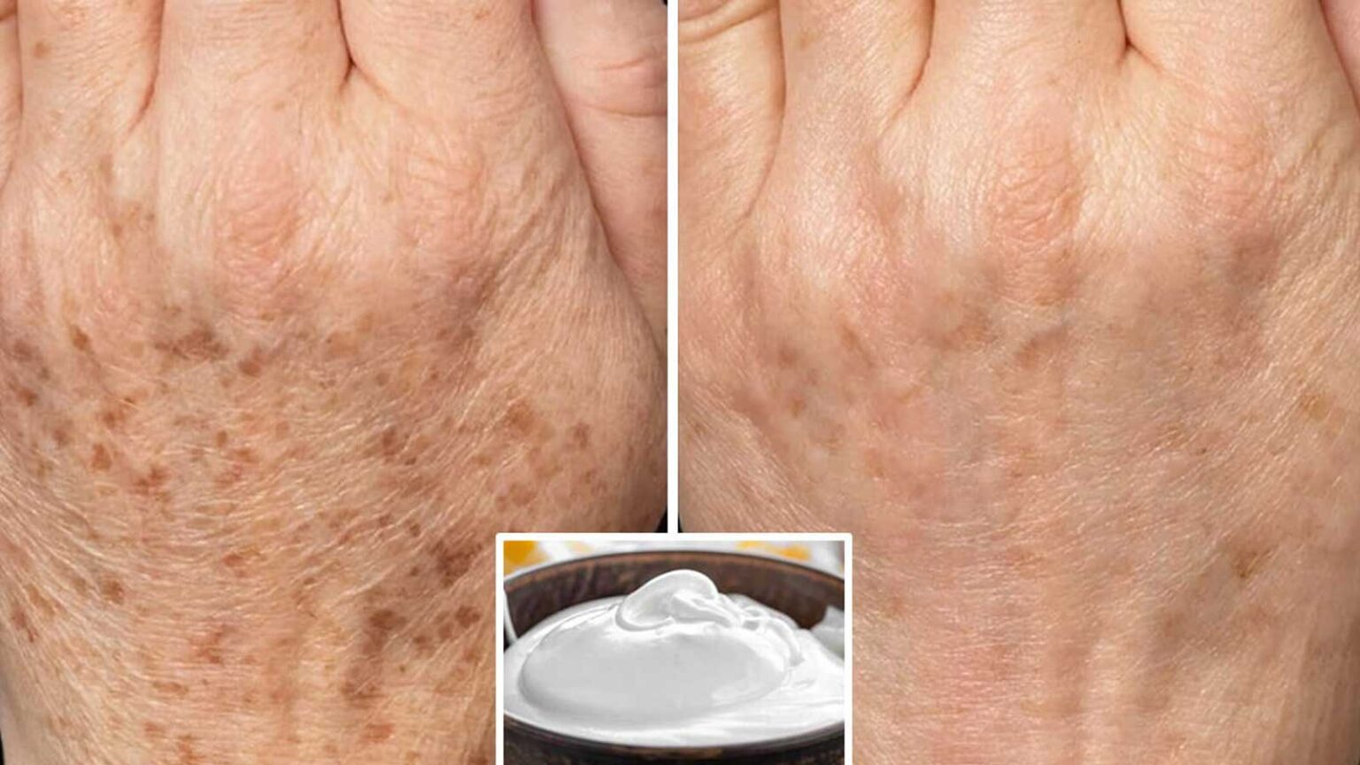 Ρυτίδες και Πανάδες Στα Χέρια: Μάσκα από Ασπράδι Αυγού για να Αναζωογονήσετε τα Χέρια σας Κατά 15 Χρόνια