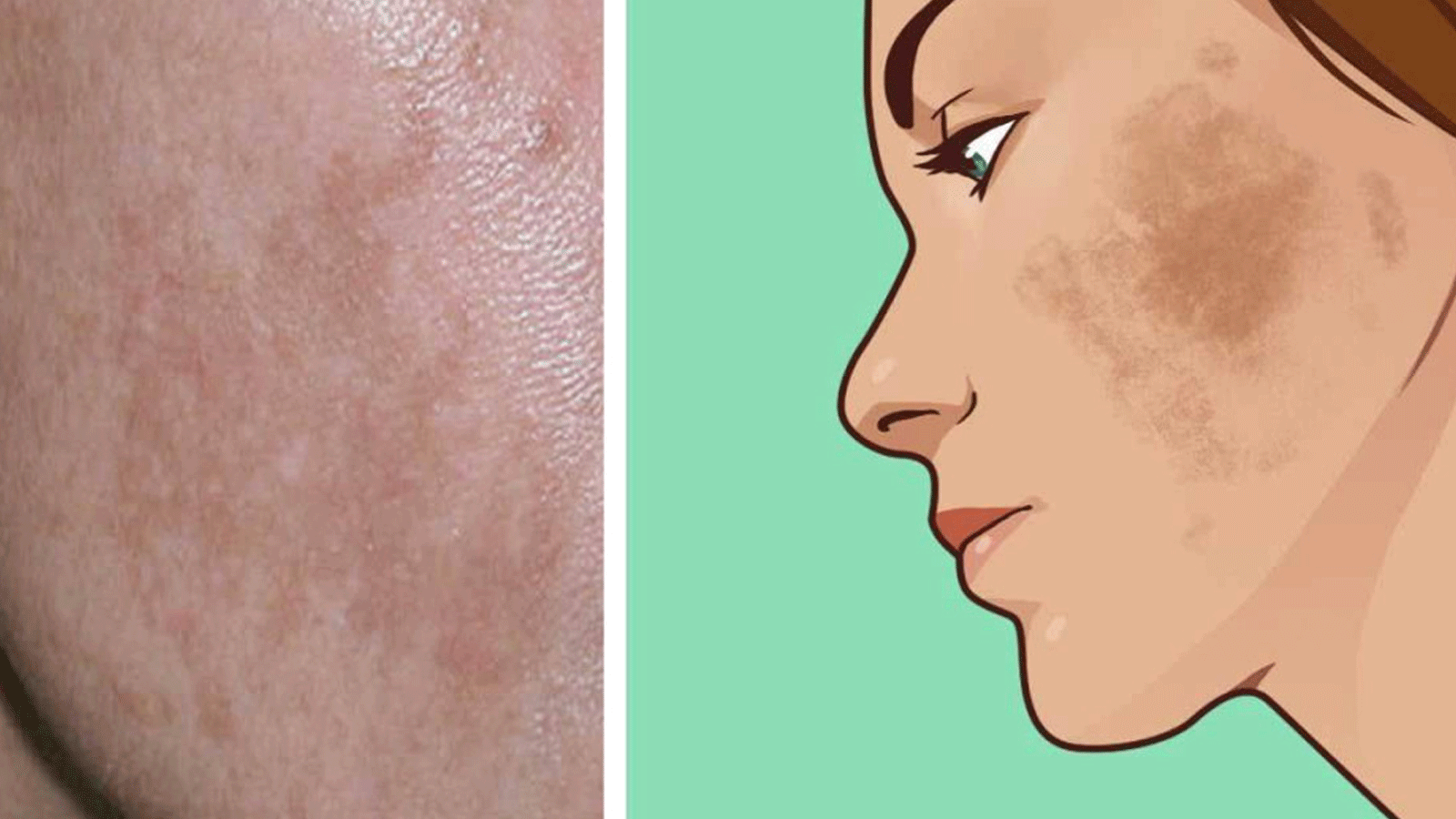 Πανάδες: 6 Φυσικούς τρόπους για να αντιμετωπίσετε άμεσα τον αποχρωματισμό του δέρματος