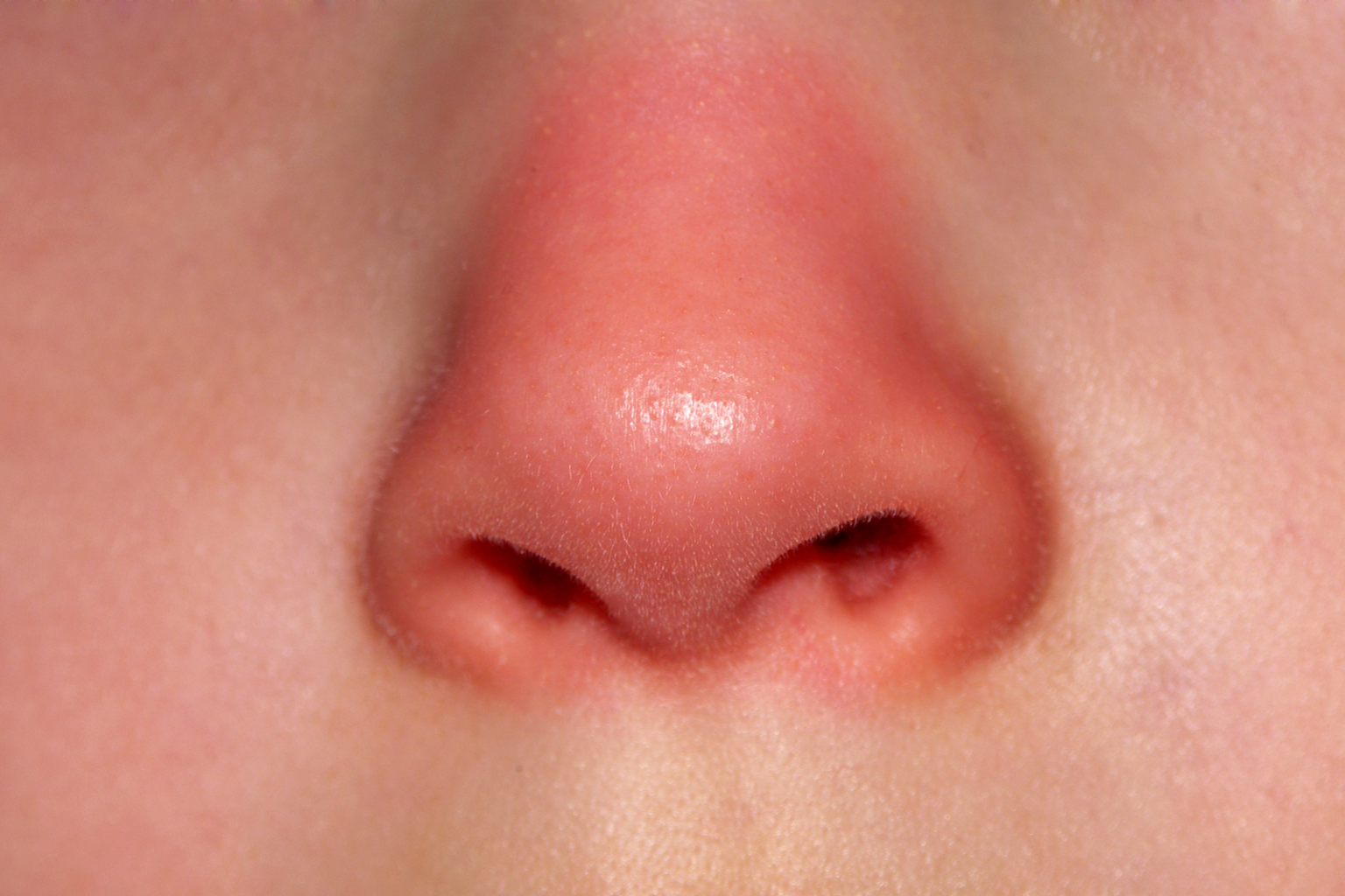 Κόκκινη Μύτη: Γιατί η Μύτη σας Κρυώνει Πάντα Ακόμα και Όταν Δεν Είναι Χειμώνας