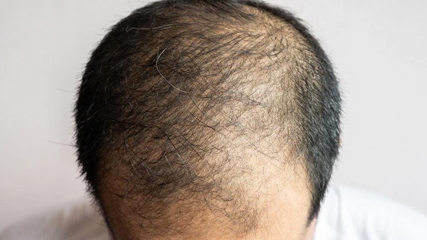 Φυσική μάσκα για δυνατά, υγιή μαλλιά με Σκόρδο και Κρεμμύδι