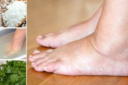 Πρησμένα Πόδια: Σπιτικές Θεραπείες για να ανακουφιστείς