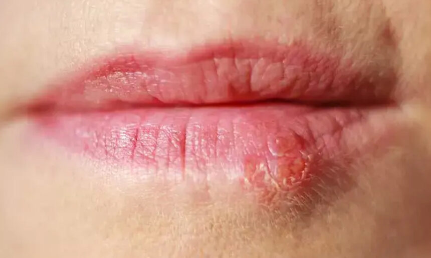 Σπυράκι στα χείλια ή έρπης: Πώς να το ξεχωρίσετε