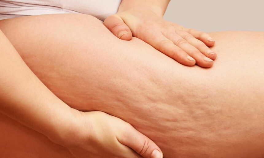 Κυτταρίτιδα: Σπιτική φυσική κρέμα με 4 υλικά που μπορείς να φτιάξεις σήμερα