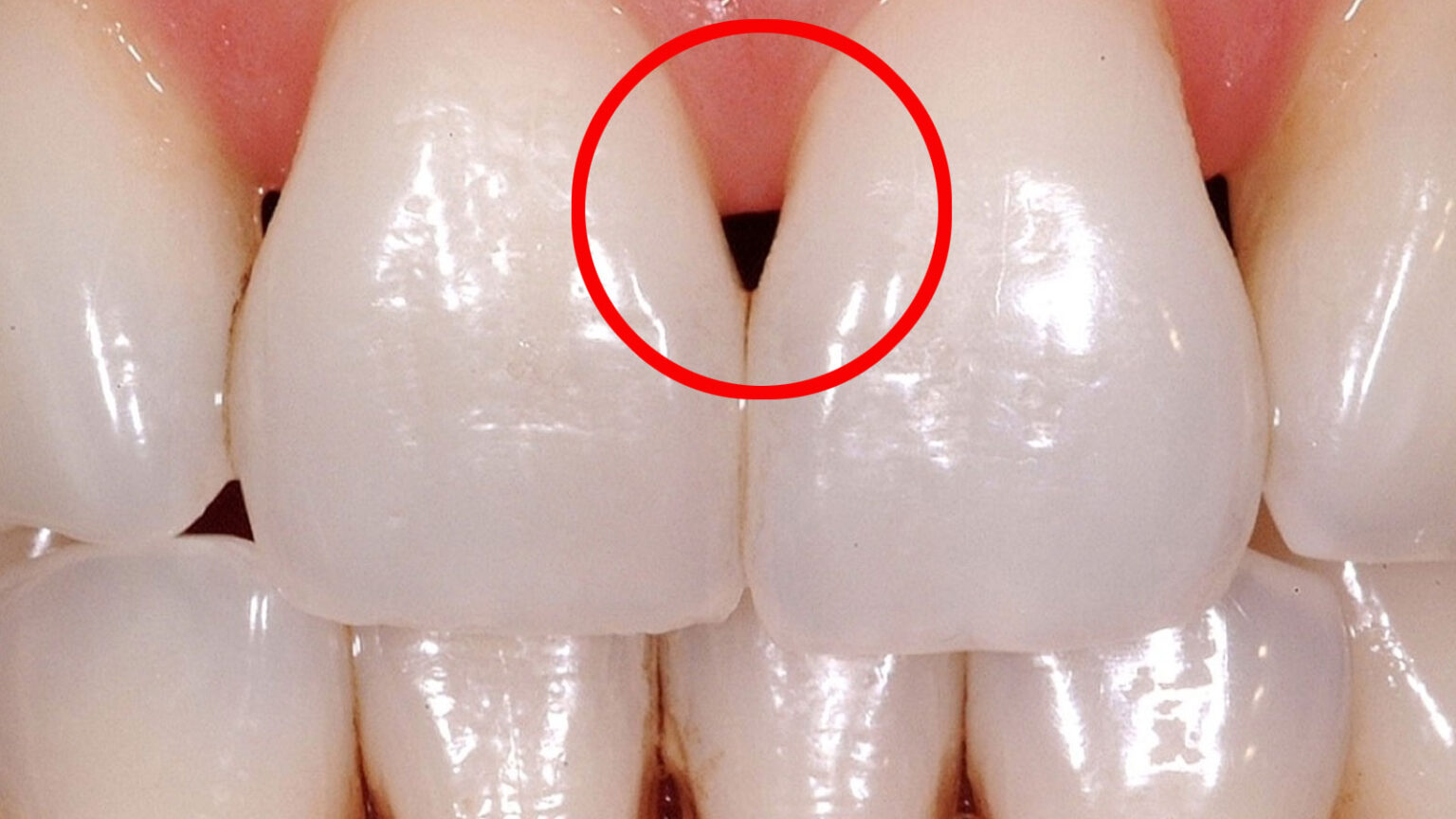 Μαύρα Τρίγωνα στα Δόντια: Τι Είναι και τι να Κάνετε για Αυτά