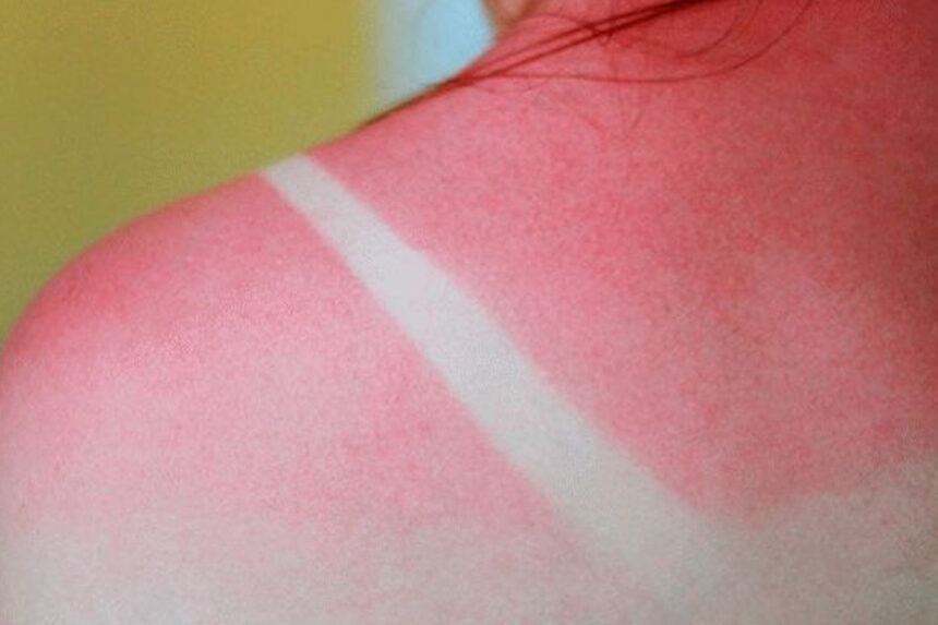 Ηλιακό Έγκαυμα: Δερματολόγος απαντά πώς να τα αντιμετωπίσεις στο σπίτι