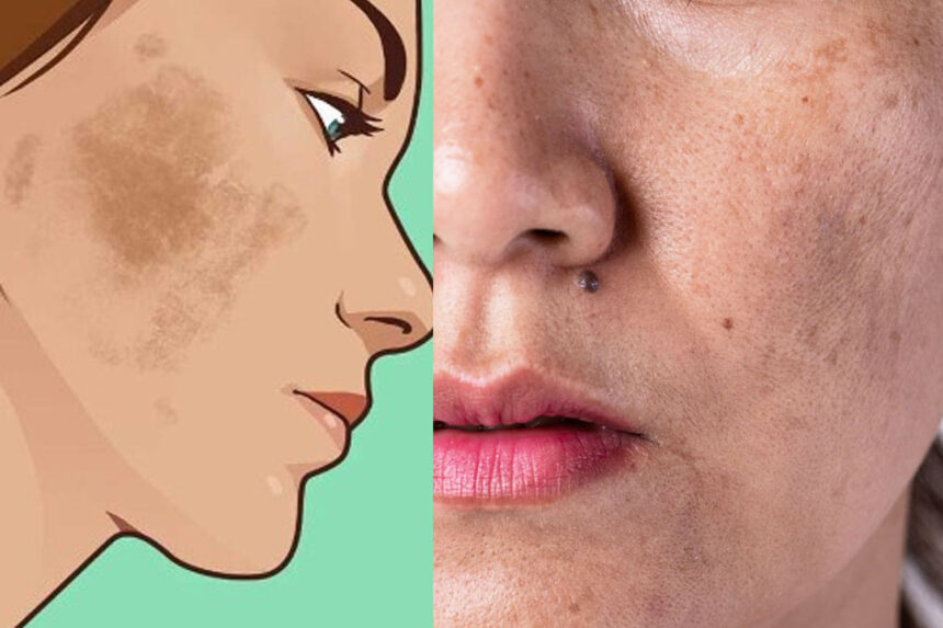 Αποχρωματισμός δέρματος και πανάδες: 6 φυσικοί τρόποι να το διορθώσεις