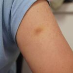 Κάνεις εύκολα μελανιές και μώλωπες; 5 Λόγοι