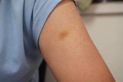 Κάνεις εύκολα μελανιές και μώλωπες; 5 Λόγοι