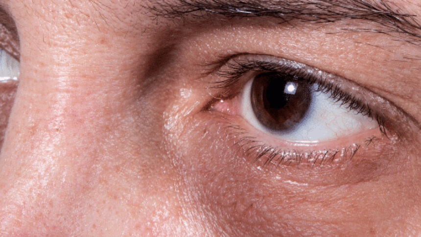 Μαύροι κύκλοι στα μάτια: Πώς να τους ξεφορτωθείς με φυσικό τρόπο