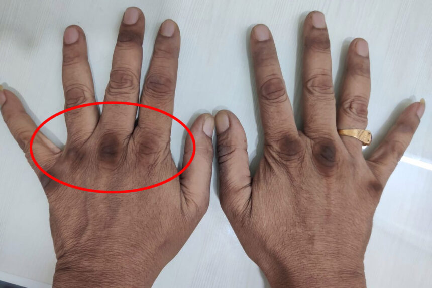 4 Φυσικές Θεραπείες Ομορφιάς για να Απαλλαγείτε από τις Σκούρες Αρθρώσεις στα δάχτυλα