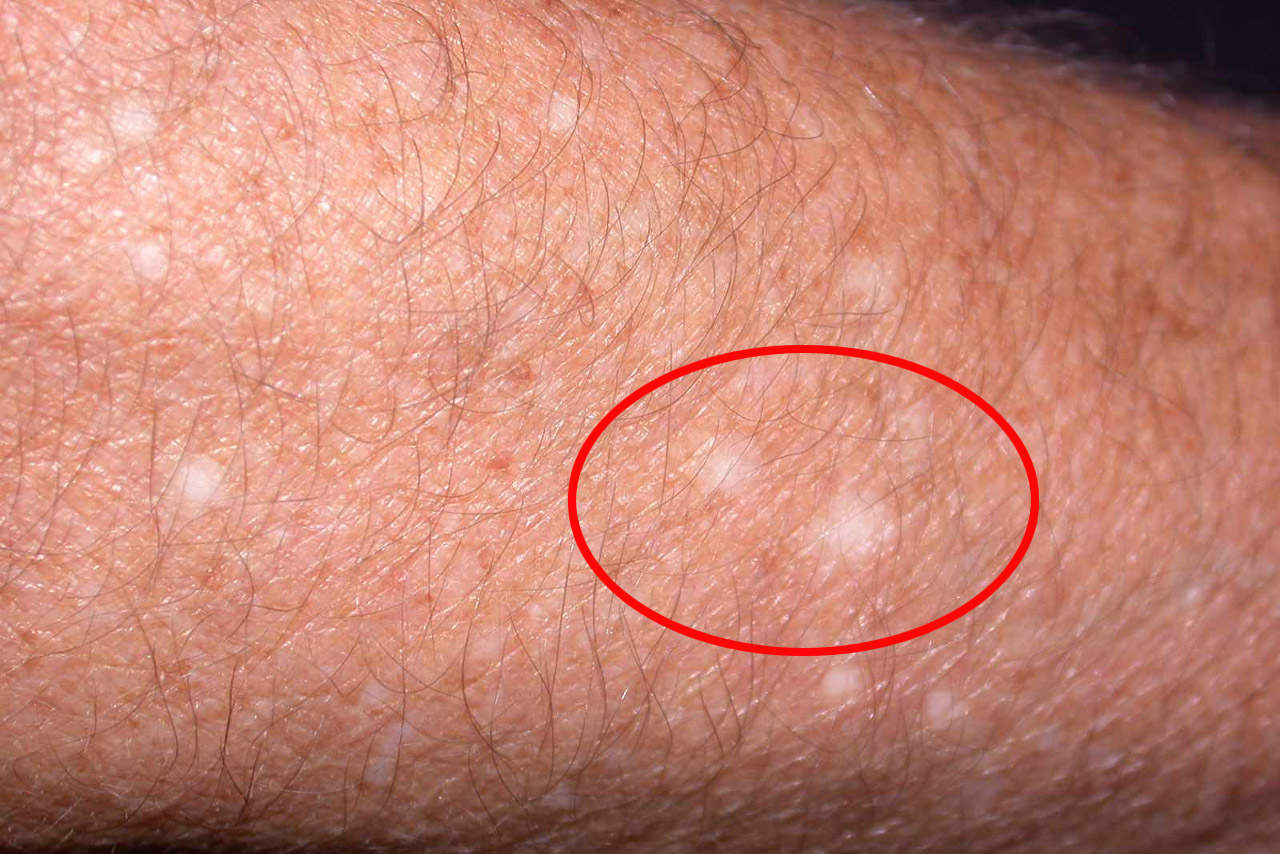 Λευκά στίγματα στο δέρμα: ποιες ελλείψεις βιταμινών μπορεί να τα προκαλούν