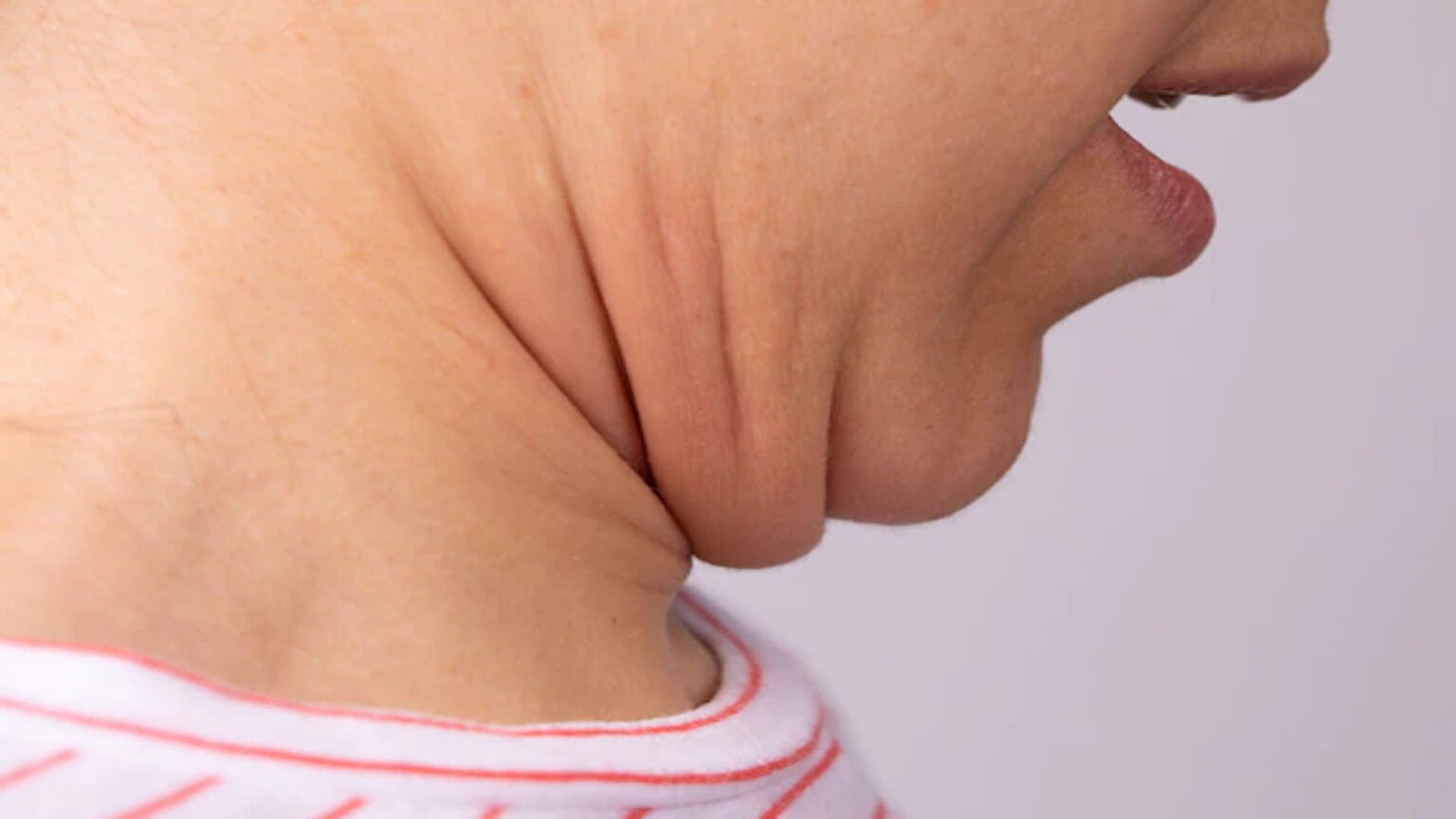 Προγούλι στο λαιμό ή αλλιώς λαιμός γαλοπούλας: 7 τροφές που βοηθούν να σφίξει φυσικά το δέρμα