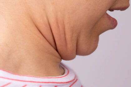 Προγούλι στο λαιμό ή αλλιώς λαιμός γαλοπούλας: 7 τροφές που βοηθούν να σφίξει φυσικά το δέρμα