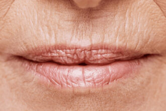 Ρυτίδες γύρω από το στόμα: Εμφανίζονται πιο γρήγορα από όσο νομίζεις - Πώς να τις αντιμετωπίσεις