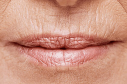Ρυτίδες γύρω από το στόμα: Εμφανίζονται πιο γρήγορα από όσο νομίζεις - Πώς να τις αντιμετωπίσεις